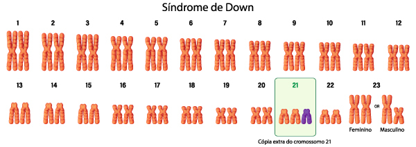 Cariótipo de uma pessoa com síndrome de Down, uma doença genética. 