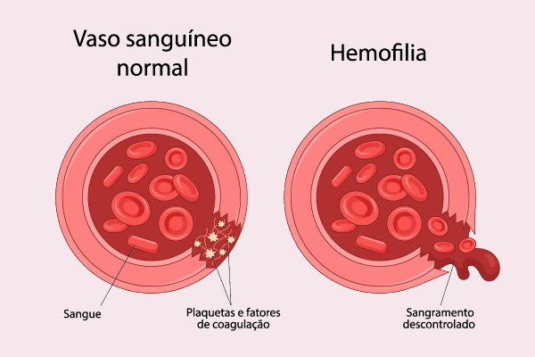 Representação da coagulação normal do sangue e do sangramento prolongado característico da hemofilia.