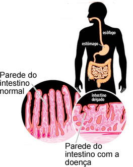 Doença celíaca. Causas e sintomas da doença celíaca - Brasil Escola
