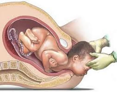 O parto normal tem mais benefícios do que a cesariana
