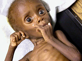 Criança africana com aspecto de profunda subnutrição.