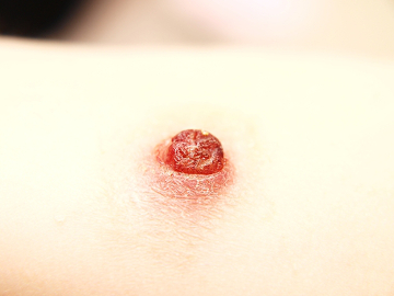 A aplicação da vacina BCG provoca uma pequena lesão que posteriormente origina um cicatriz característica