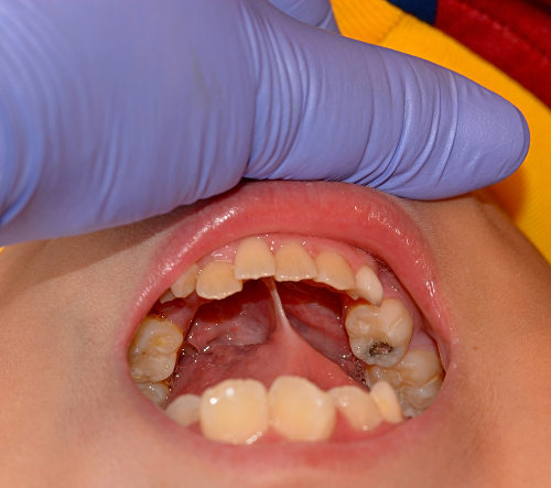 A cárie é uma deterioração do dente