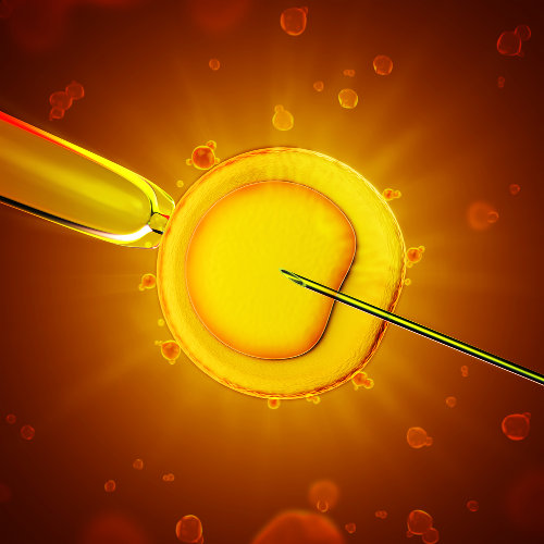 A fertilização in vitro pode ser feita por meio da injeção intracitoplasmática de espermatozoide