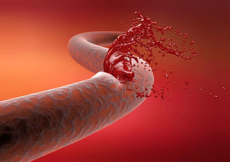 A hemorragia ocorre quando um vaso sanguíneo é lesionado e há extravasamento de sangue