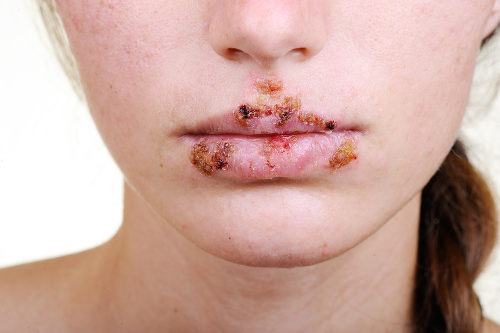 A herpes labial pode ser transmitida pelo beijo