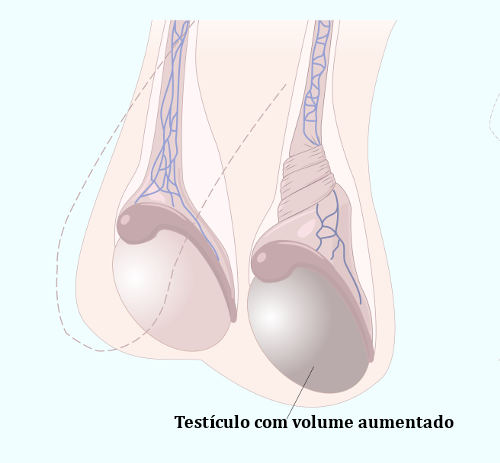 A torção do cordão espermático provoca a interrupção do fluxo sanguíneo no testículo afetado