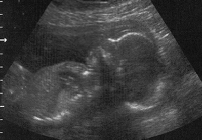 Imagem de um feto obtida com a técnica de ultrassonografia