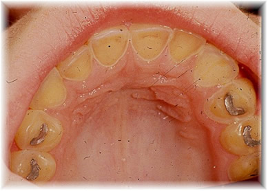 A bulimia leva à rápida deterioração dos dentes