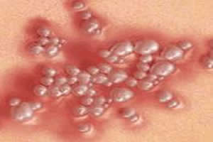 Lesões típicas do herpes genital