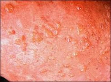 A dermatite herpetiforme é uma variante da doença celíaca