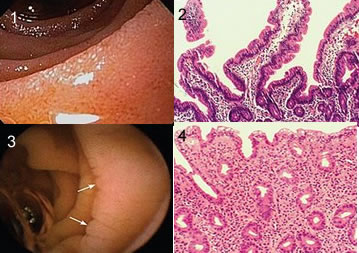 Nas figuras 1 e 2 podemos observar a imagem do intestino de uma pessoa normal, enquanto que nas figuras 3 e 4 observamos a imagem do intestino de uma pessoa com doença celíaca
