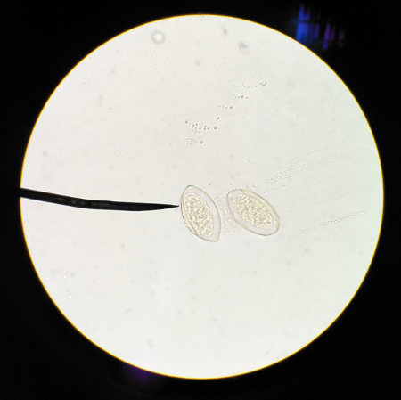 O Diphyllobothrium é causador da difilobotríase. Na figura, temos um ovo do parasita