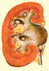 Esquema anatômico do sistema urinário contendo cálculo renal