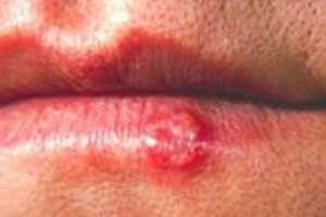 Ferida típica do herpes