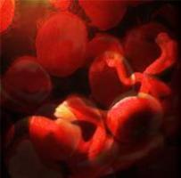 A eritroblastose fetal atinge 1 criança a cada 200 nascidos