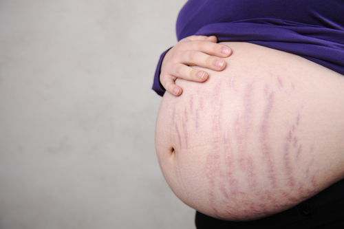 Estrias avermelhadas localizadas na barriga de uma mulher grávida