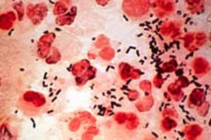 Células infectadas pela gonorreia