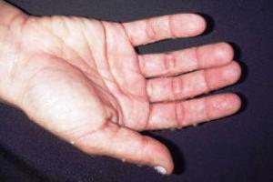 Suor excessivo nas mãos pode ser sintoma da hipersudorese