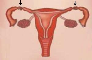 A laqueadura consiste em uma intervenção cirúrgica nas tubas uterinas.