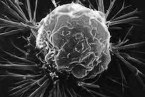 O câncer ataca células vizinhas e pode se espalhar pelo corpo da pessoa acometida