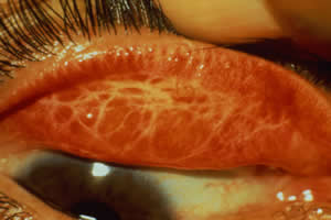 Lesões na conjuntiva, típicas do tracoma
