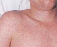 Característica de rubéola: manchas avermelhadas na pele