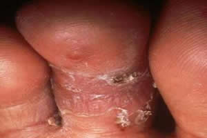 Micose: infecção fúngica bastante incômoda