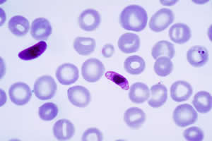 Plasmodium falciparum em amostra de sangue