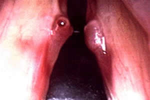 Dois pólipos localizados nas pregas vocais