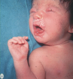 Sífilis congênita: contágio do Treponema pallidum através da gestante infectada para o bebê