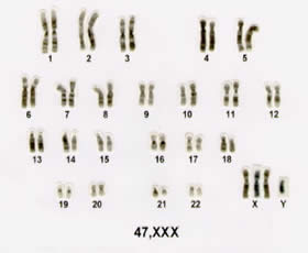 Aneuploidias dos cromossomos sexuais