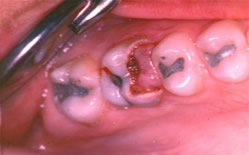 Pulpite: inflamação da polpa dentária