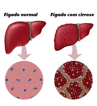 A cirrose ocasiona a fibrose do fígado e o surgimento de nódulos
