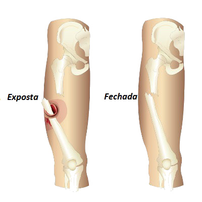 Tipos de Fratura