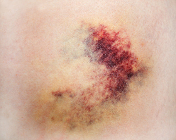 A aplicação do sangue de maneira incorreta na auto-hematoterapia pode gerar o surgimento de hematomas.