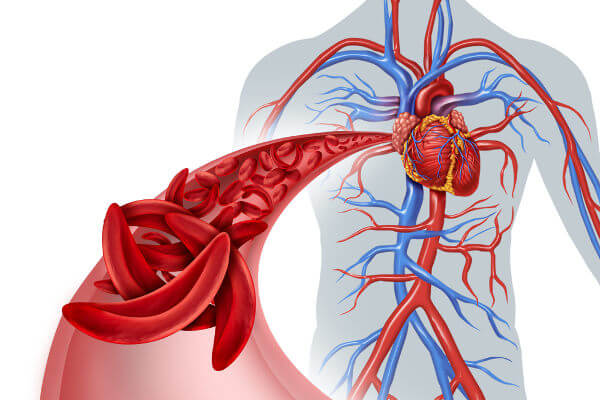 Na anemia falciforme as hemácias apresentam uma forma de foice.