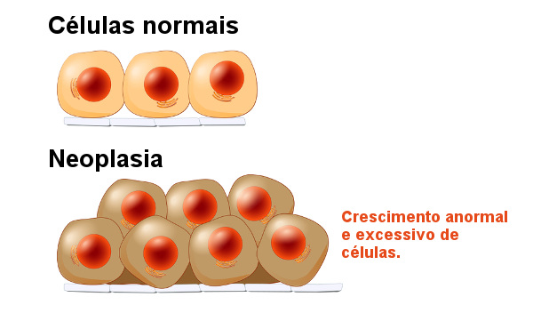 Nas neoplasias ocorre o aumento anormal de células.