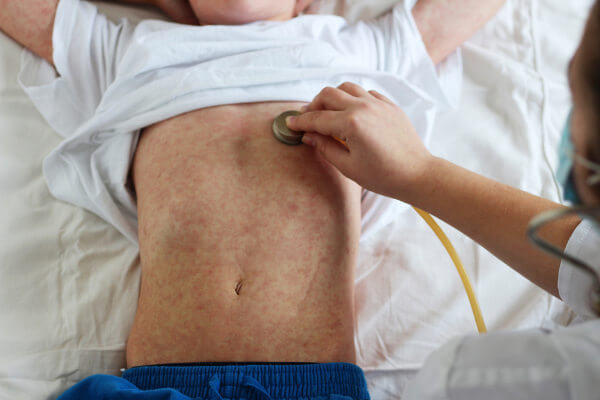 O sarampo pode provocar febre e manchas no corpo.